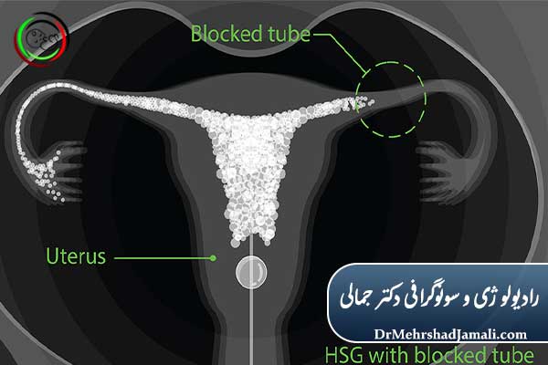 مزیت‌های انجام HSG