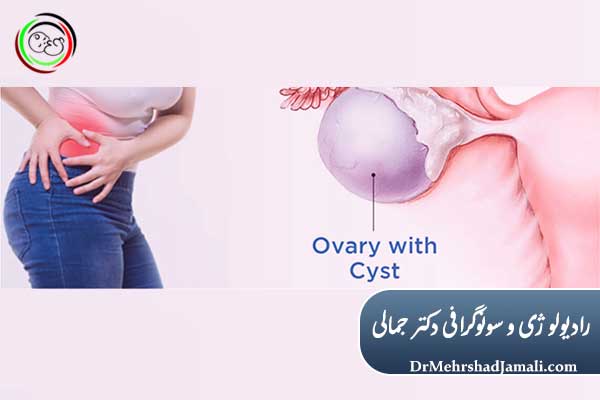 علائم بروز کیست تخمدان