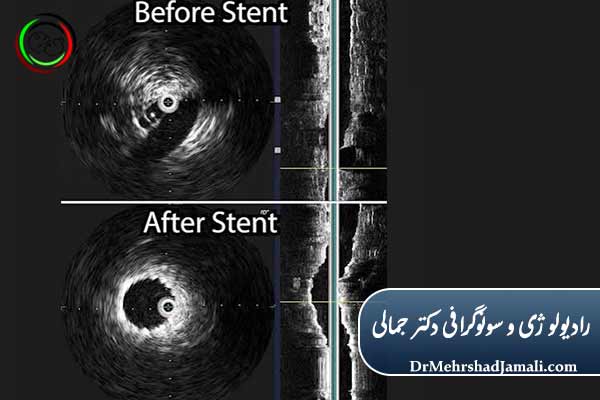  ونوپلاستی و استنت‌گذاری با سونوگرافی داپلر