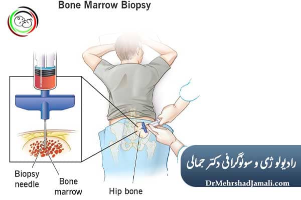 عوارض احتمالی بیوپسی مغز استخوان