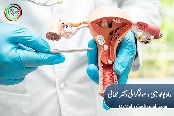 سونوگرافی مپینگ اندومتریوز چیست