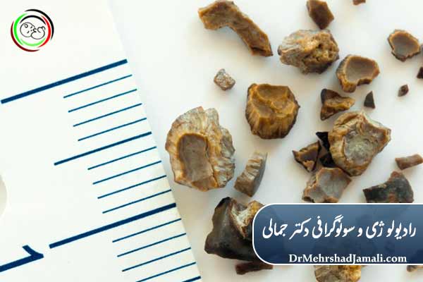 سنگ کلیه: علل و عوارض