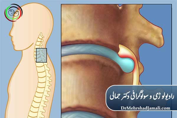 مزایای درمان دیسک کمر با تزریق ژل
