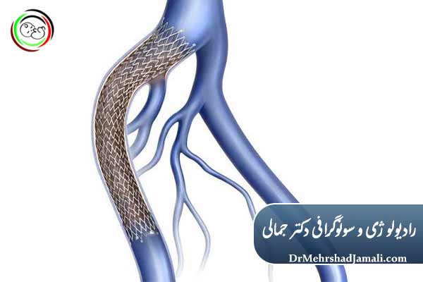 ونوپلاستی 