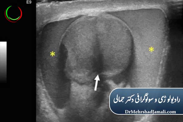 سونوگرافی داپلر بیضه