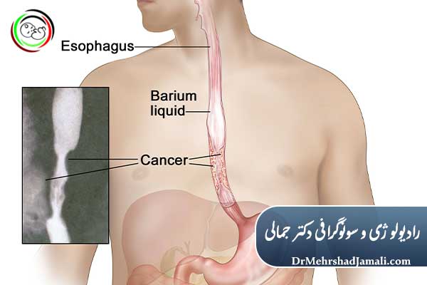 آمادگی برای انجام بلع باریم