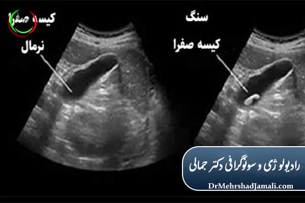 علت‌های شایع درد شکم سمت راست