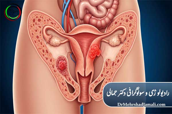 کیست تخمدان چیست؟