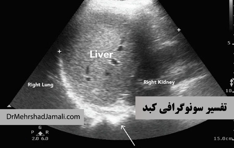 خواندن برگه سونوگرافی کبد 