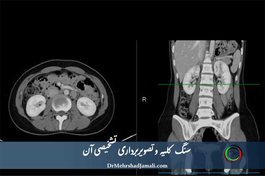 سنگ کلیه و روش‌های تصویربرداری تشخیصی | پیشگیری و درمان سنگ کلیه