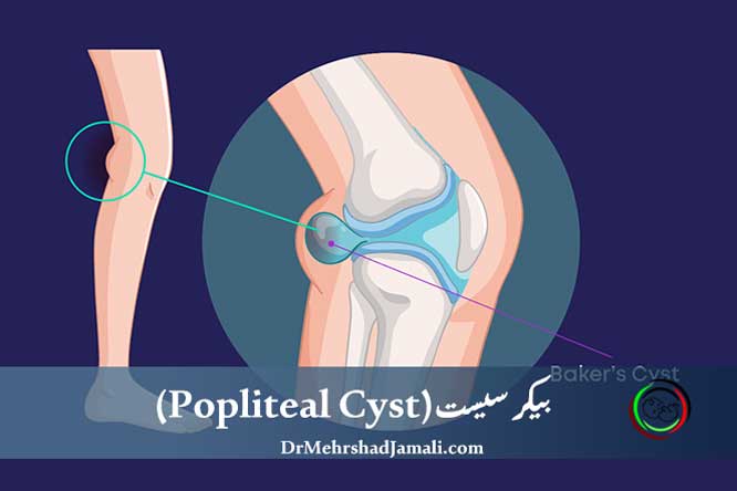 کیست پشت زانو | بیکر سیست