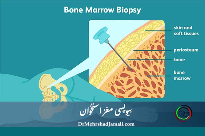 انجام بیوپسی مغز استخوان در مرکز تصویربرداری دکتر مهرشاد جمالی