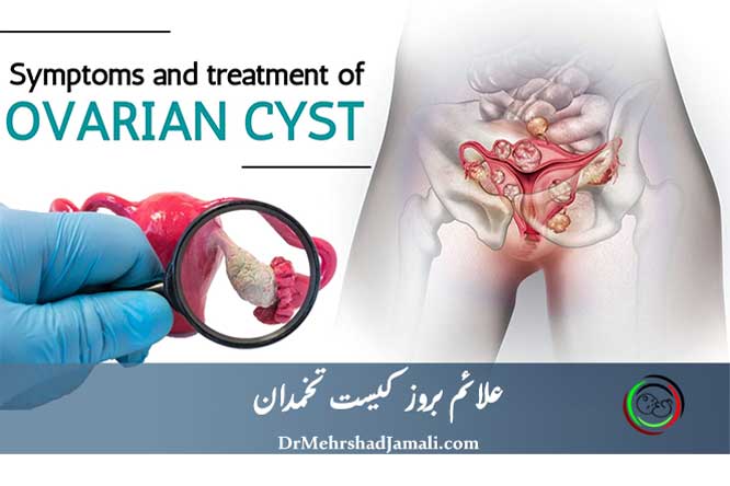 علائم بروز کیست تخمدان | تشخیص و درمان کیست تخمدان
