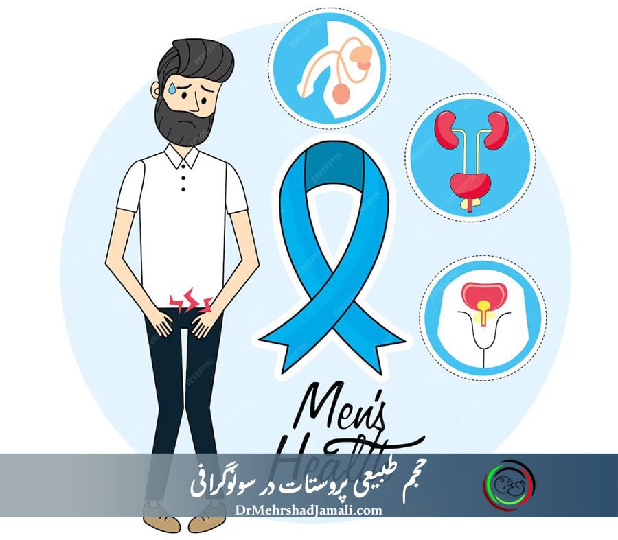 حجم طبیعی پروستات در سونوگرافی 