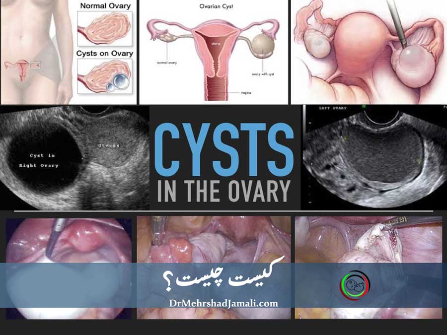 تصویربرداری و تشخیص کیست با سونوگرافی در تهران | مرکز دکتر مهرشاد جمالی