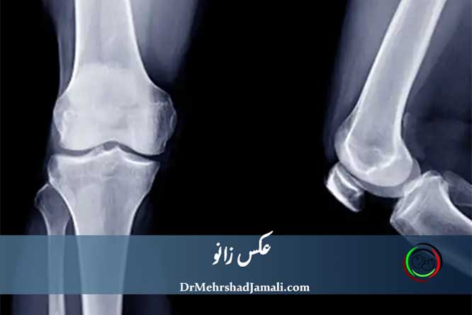 رادیولوژی زانو | عکس زانو