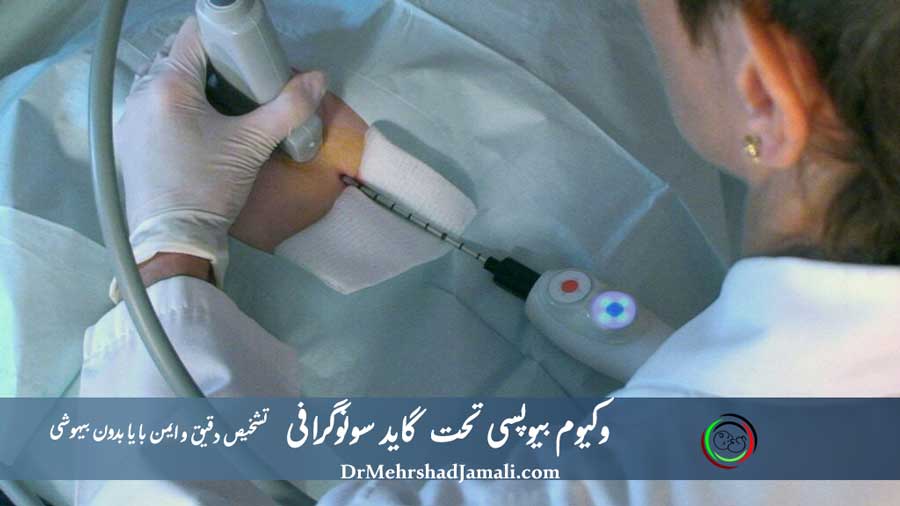 وکیوم بیوپسی تحت گاید سونوگرافی با بیهوشی و بدون بیهوشی