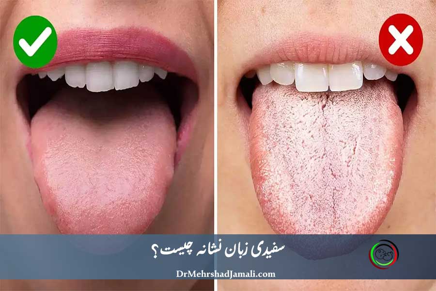 سفیدی زبان نشانه چیست؟ | علت سفیدی زبان