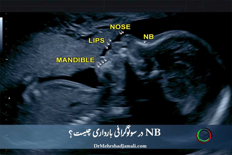 NB در سونوگرافی بارداری چیست؟ | بهترین مرکز سونوگرافی NB 