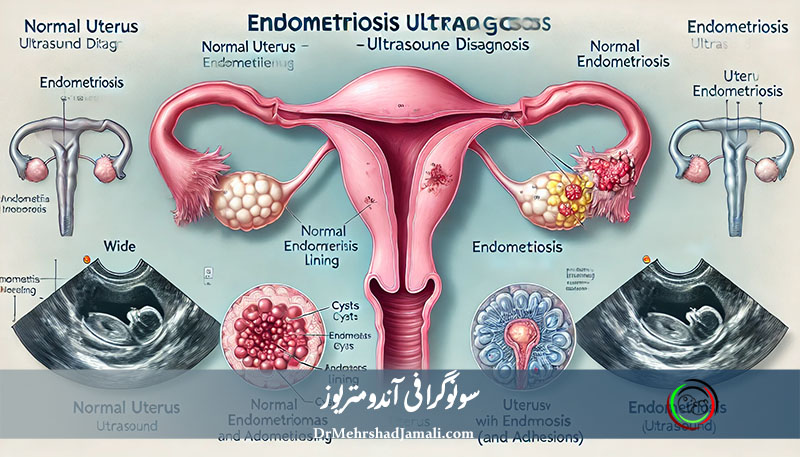 بهترین سونوگرافی آندومتریوز | بهترین مرکز آندومتریوز