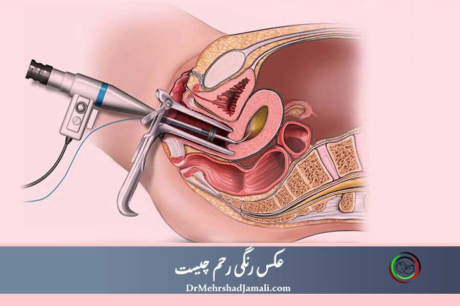 عکس رنگی رحم 