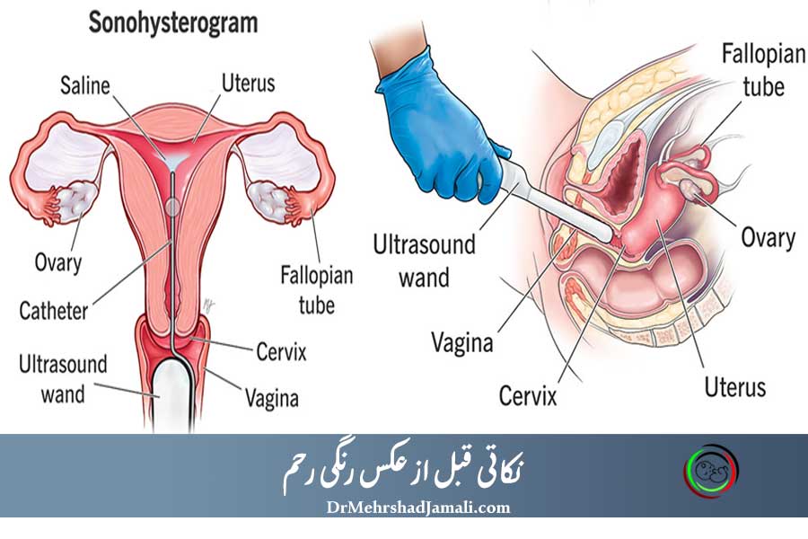 آمادگی قبل از عکس رنگی رحم (HSG  یا هیستروسالپنگوگرافی )