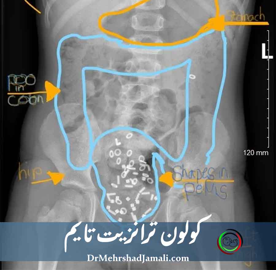 آزمایش کلون ترانزیت تایم ( زمان عبور روده بزرگ)