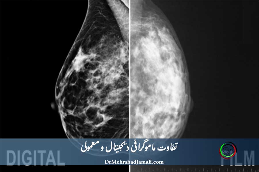 تفاوت ماموگرافی دیجیتال و معمولی 