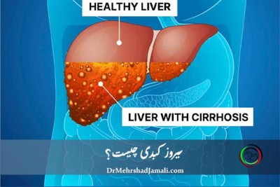سیروز کبدی | علائم، علت‌ها، روش تشخیص