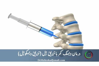 درمان دیسک کمر با تزریق ژل (دیسکوژل) تحت هدایت تصویربرداری