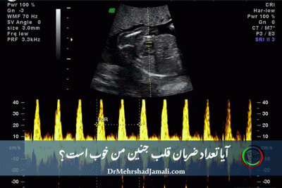 سونوگرافی بارداری برای بررسی تعداد ضربان قلب جنین در مرکز دکتر مهرشاد جمالی
