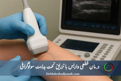 درمان واریس با تزریق تحت هدایت سونوگرافی
