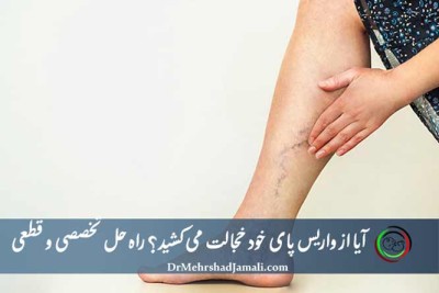 قبل و بعد درمان واریس پا