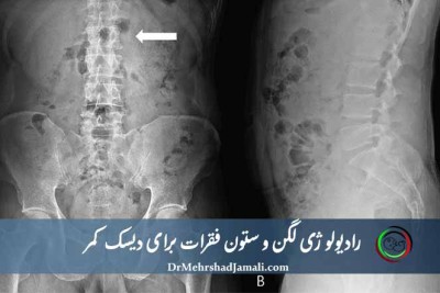 رادیولوژی لگن و ستون فقرات برای بررسی دیسک کمر در مرکز تصویربرداری تهران