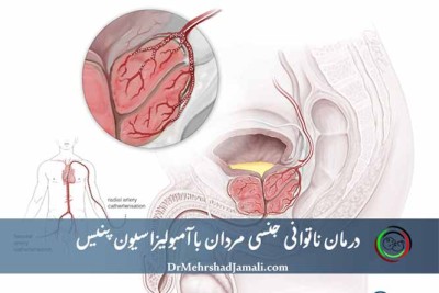درمان ناتوانی جنسی مردان با آمبولیزاسیون پنیس بدون جراحی