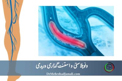 ونوپلاستی و استنت‌گذاری وریدی - درمان واریس پا