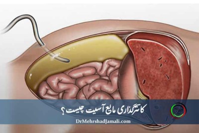 تخلیه مایع آسیت با هدایت سونوگرافی در تهران