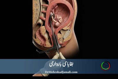 بقایای بارداری یعنی چه ؟ 