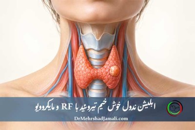 RF یا مایکروویو ندول تیروئید