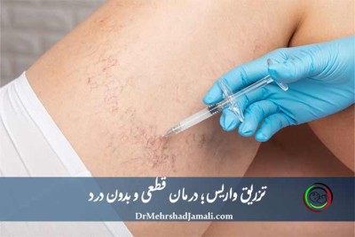 درمان واریس با تزریق بدون جراحی