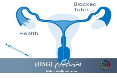 تصویر هیستروسالپنگوگرام (HSG) نشان‌دهنده مسیر ماده حاجب در رحم و لوله‌های رحمی