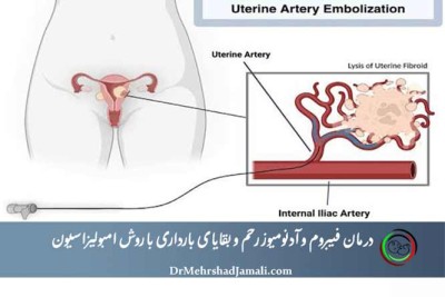درمان فیبروم رحم با روش امبولیزاسیون در مرکز تخصصی دکتر مهرشاد جمالی - بیمارستان آپادانا تهران