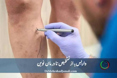 درمان واریس با سونوگرافی داپلر در مرکز دکتر مهرشاد جمالی