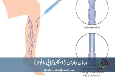 درمان واریس، اسکلروتراپی با فوم (UGFS) در تهران